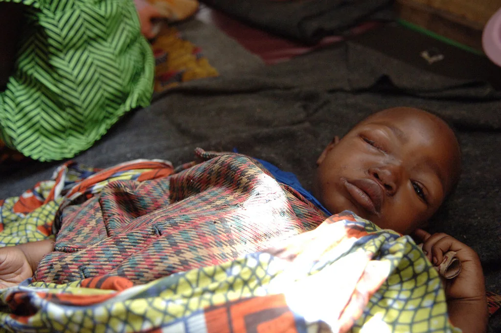 Un niño de cinco años que sufre de viruela de la simia descansa en un centro de salud en un campamento de desplazados en Kivu del Norte, en la República Democrática del Congo (foto de archivo).