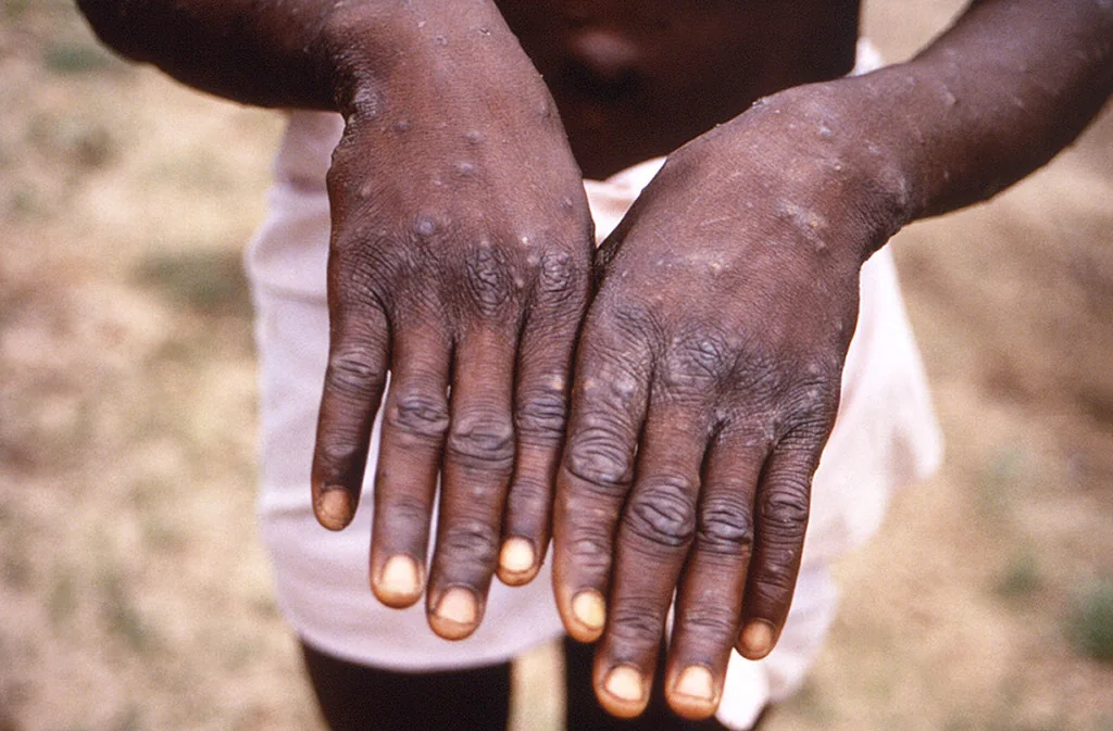 Un joven muestra sus manos durante un brote de viruela del mono en la República Democrática del Congo (foto de archivo).