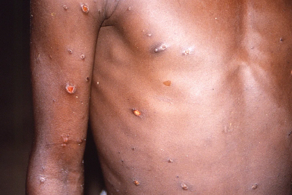 La viruela del mono produce lesiones cutáneas, fiebre y dolor corporal en las personas afectadas por el virus.
